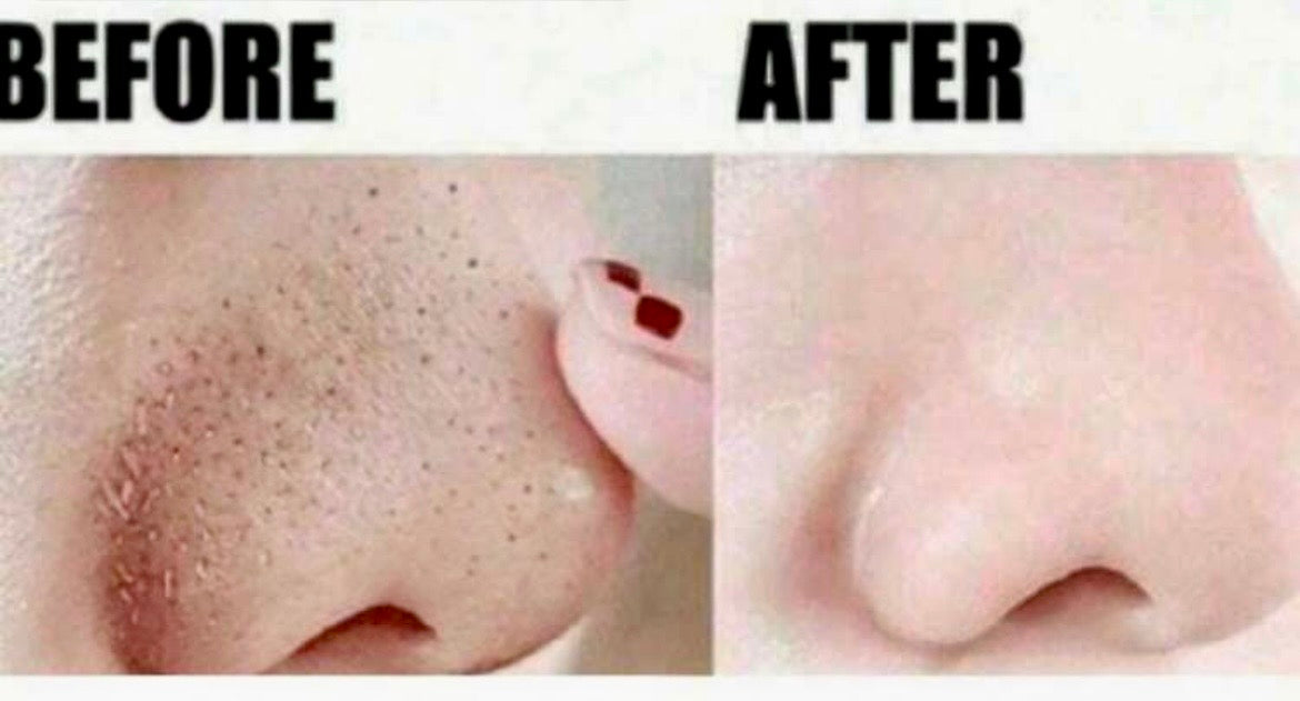 Blackhead nose pore strips
